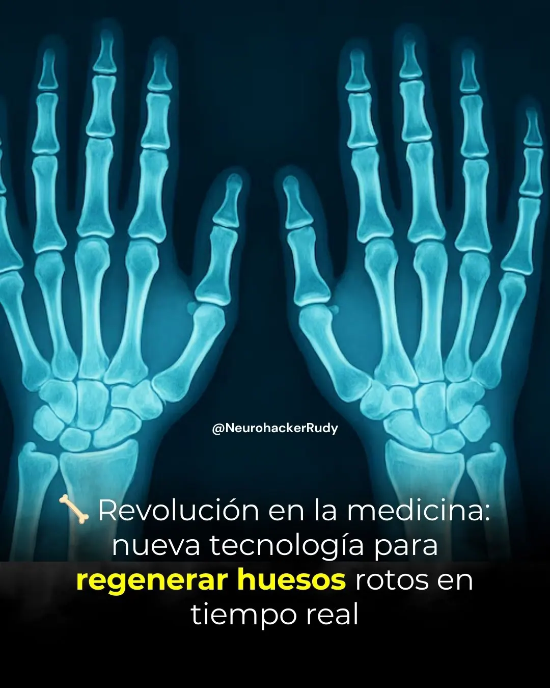 🦴 Révolution dans la médecine : une nouvelle technologie pour régénérer les os fracturés en temps réel